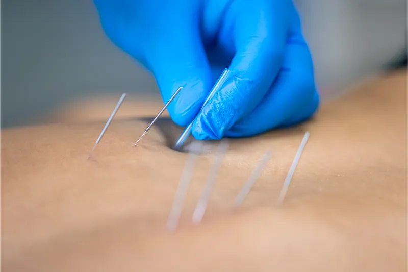 close up of a needle and hands of physiotherapist 2023 11 27 04 51 46 utc
